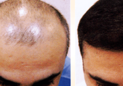 Roots Hair Transplant Laser Centre